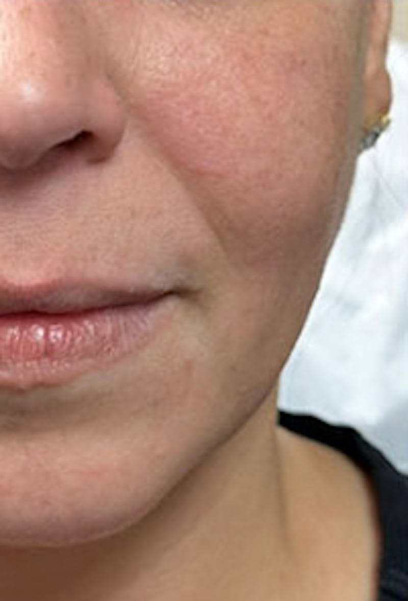 Cheek Fillers Before & After Gallery - Patient 320986 - Image 1