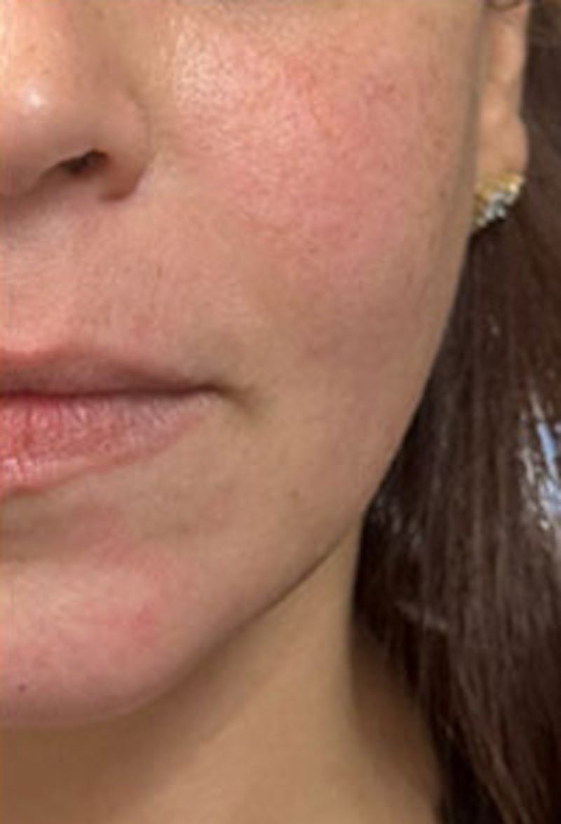 Cheek Fillers Before & After Gallery - Patient 320986 - Image 2