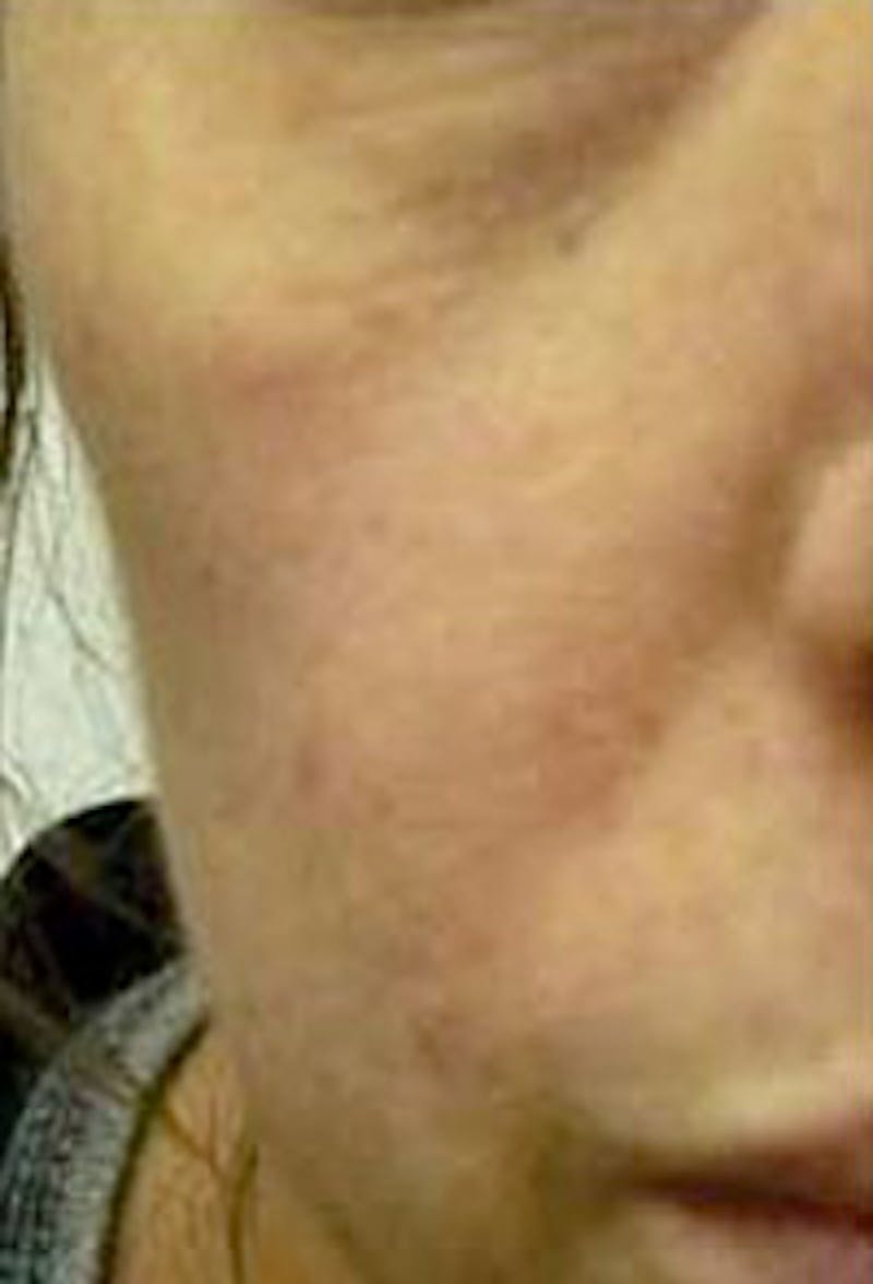 Cheek Fillers Before & After Gallery - Patient 385317 - Image 1