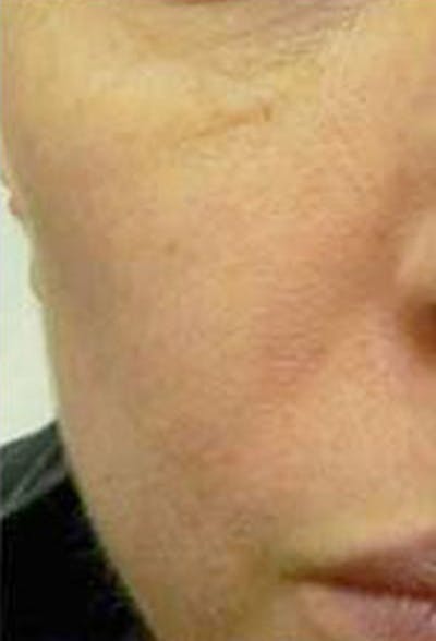 Cheek Fillers Before & After Gallery - Patient 385317 - Image 2