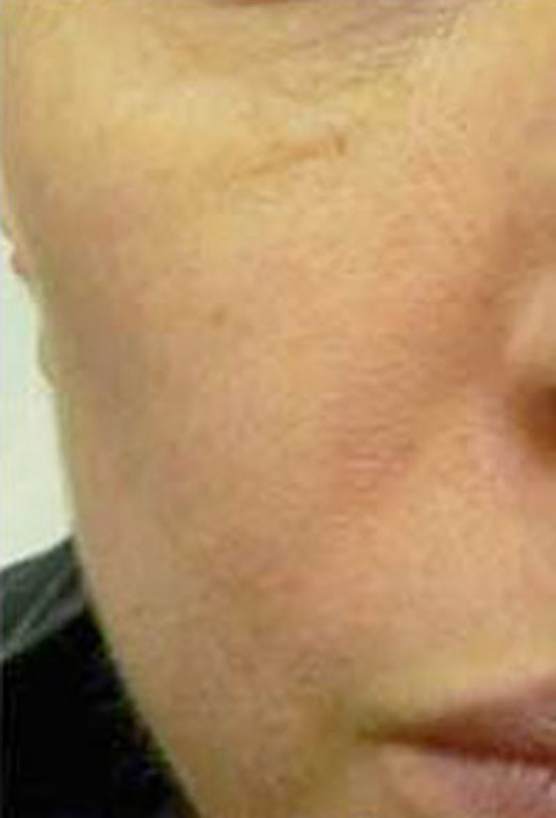 Cheek Fillers Before & After Gallery - Patient 385317 - Image 2