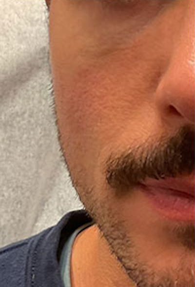 Cheek Fillers Before & After Gallery - Patient 164872 - Image 1