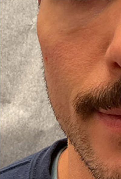 Cheek Fillers Before & After Gallery - Patient 164872 - Image 2