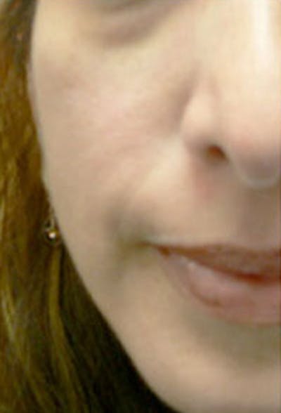 Cheek Fillers Before & After Gallery - Patient 564571 - Image 1