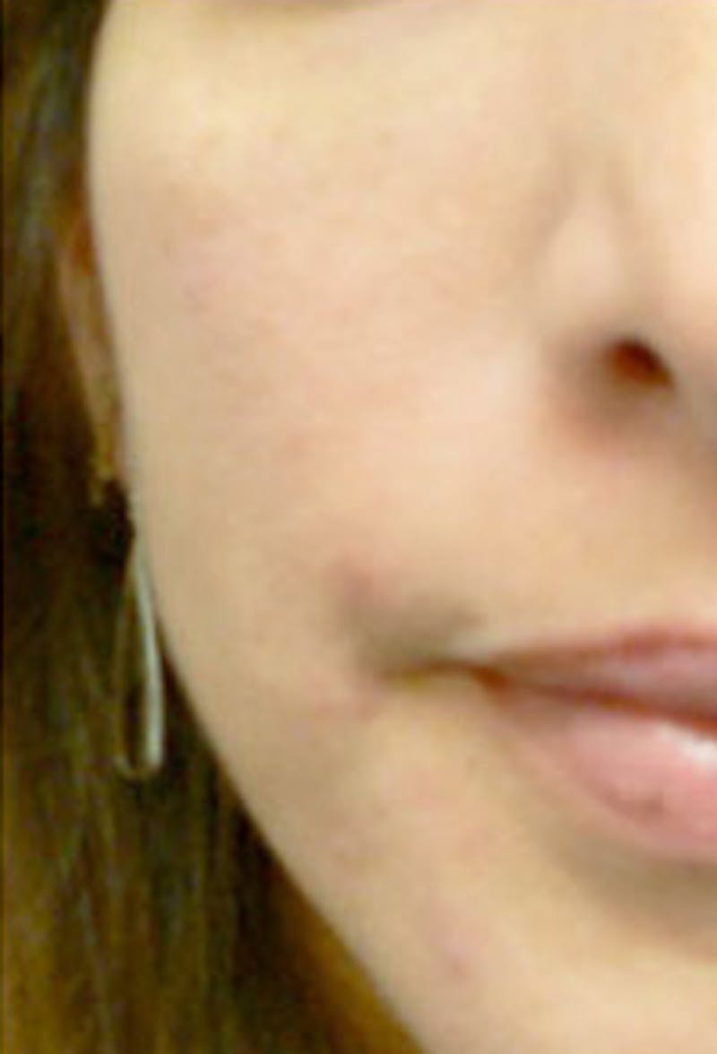 Cheek Fillers Before & After Gallery - Patient 564571 - Image 2