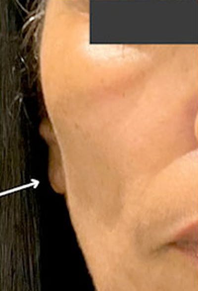 Cheek Fillers Before & After Gallery - Patient 396485 - Image 1