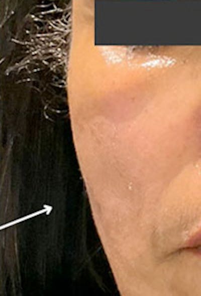 Cheek Fillers Before & After Gallery - Patient 396485 - Image 2