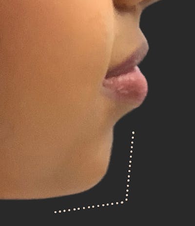 Chin Fillers Before & After Gallery - Patient 144849 - Image 1