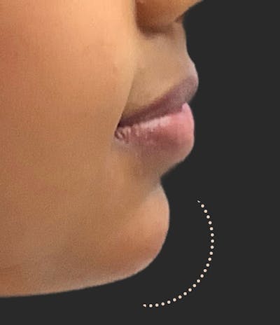 Chin Fillers Before & After Gallery - Patient 144849 - Image 2