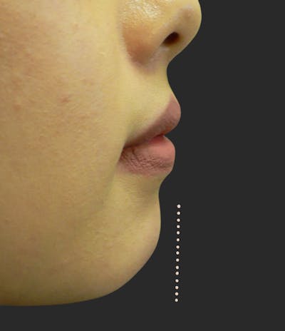 Chin Fillers Before & After Gallery - Patient 168975 - Image 1
