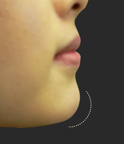 Chin Fillers Before & After Gallery - Patient 168975 - Image 2