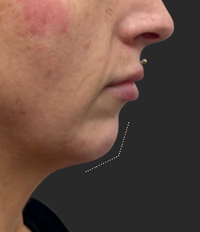 Chin Fillers Before & After Gallery - Patient 502312 - Image 1