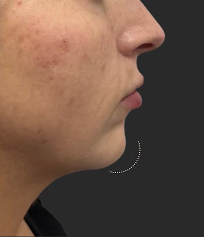 Chin Fillers Before & After Gallery - Patient 502312 - Image 2