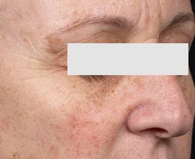 Clear + Brilliant Skin Rejuvenation Before & After Gallery - Patient 213004 - Image 1