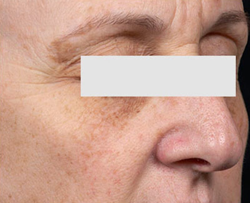 Clear + Brilliant Skin Rejuvenation Before & After Gallery - Patient 213004 - Image 2