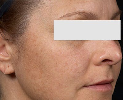 Clear + Brilliant Skin Rejuvenation Before & After Gallery - Patient 386747 - Image 1