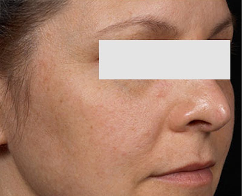 Clear + Brilliant Skin Rejuvenation Before & After Gallery - Patient 386747 - Image 2