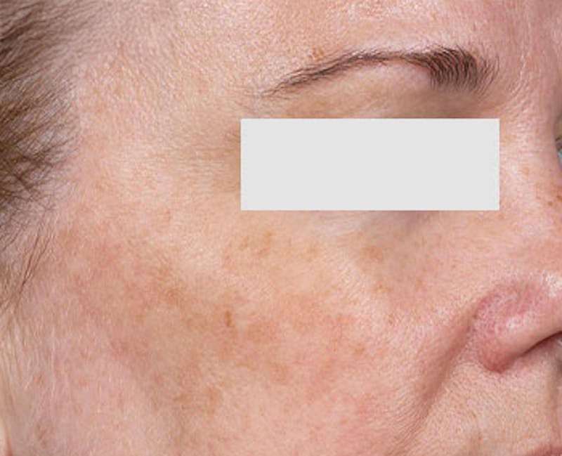 Clear + Brilliant Skin Rejuvenation Before & After Gallery - Patient 174827 - Image 1