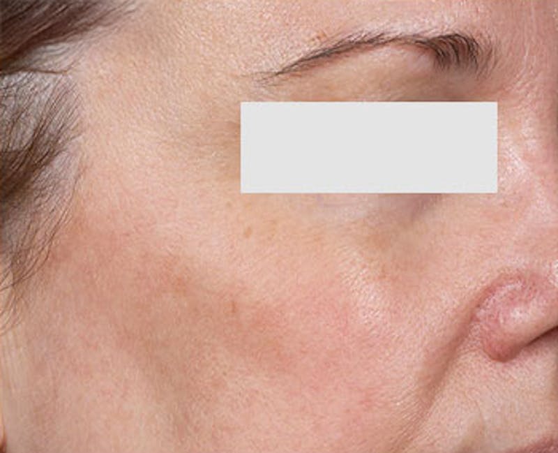 Clear + Brilliant Skin Rejuvenation Before & After Gallery - Patient 174827 - Image 2