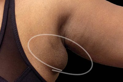 Coolsculpting Body Fat Reduction Before & After Gallery - Patient 143968 - Image 1