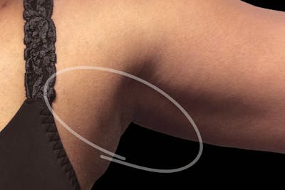 Coolsculpting Body Fat Reduction Before & After Gallery - Patient 143968 - Image 2