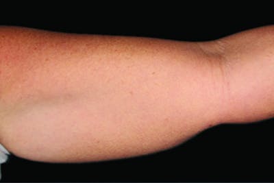 Coolsculpting Body Fat Reduction Before & After Gallery - Patient 404983 - Image 1