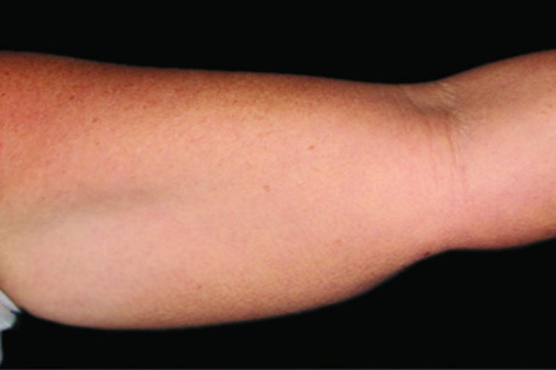 Coolsculpting Body Fat Reduction Before & After Gallery - Patient 404983 - Image 1