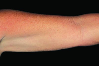 Coolsculpting Body Fat Reduction Before & After Gallery - Patient 404983 - Image 2