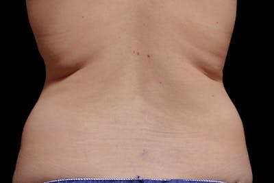 Coolsculpting Body Fat Reduction Before & After Gallery - Patient 216776 - Image 1