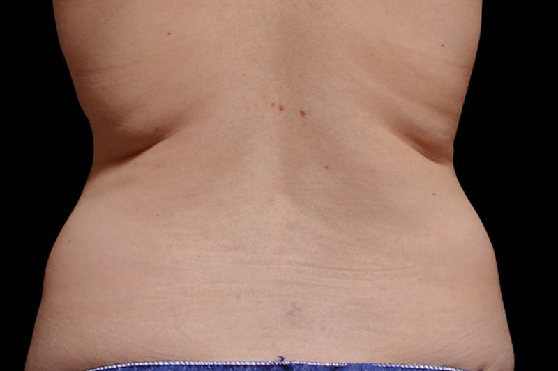 Coolsculpting Body Fat Reduction Before & After Gallery - Patient 216776 - Image 1