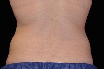 Coolsculpting Body Fat Reduction Before & After Gallery - Patient 216776 - Image 2
