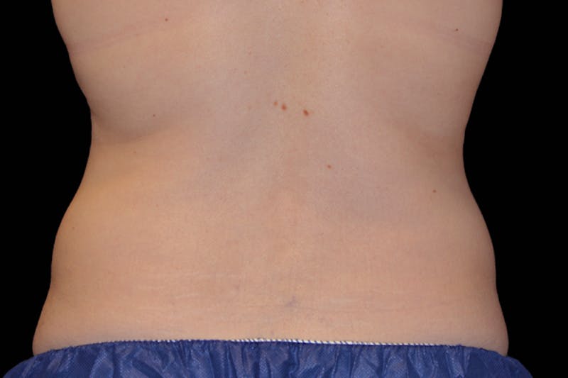 Coolsculpting Body Fat Reduction Before & After Gallery - Patient 216776 - Image 2
