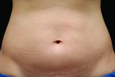 Coolsculpting Body Fat Reduction Before & After Gallery - Patient 162313 - Image 1