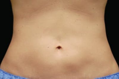 Coolsculpting Body Fat Reduction Before & After Gallery - Patient 162313 - Image 2