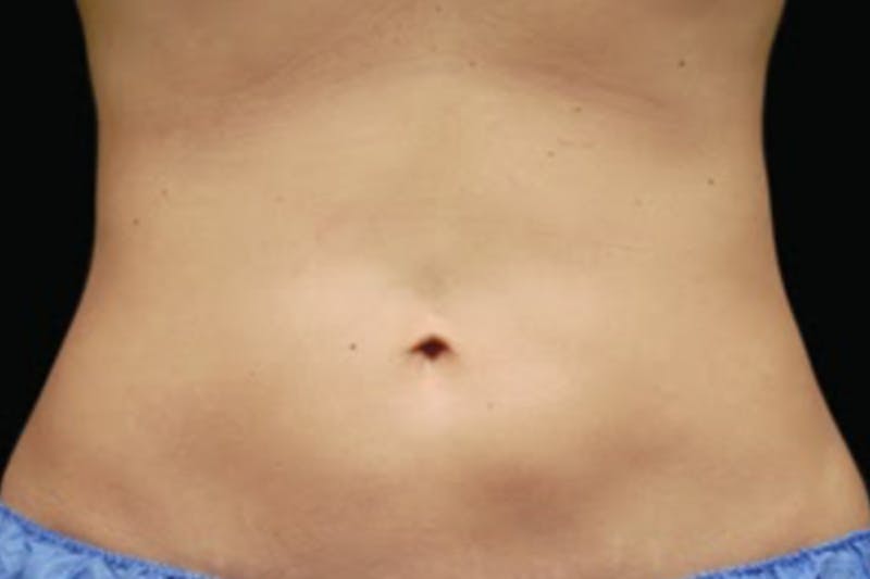 Coolsculpting Body Fat Reduction Before & After Gallery - Patient 162313 - Image 2