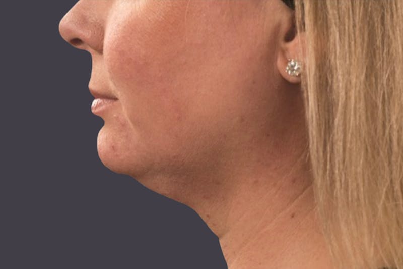 Coolsculpting Double Chin Reduction Before & After Gallery - Patient 413478 - Image 1