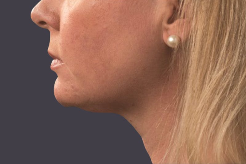 Coolsculpting Double Chin Reduction Before & After Gallery - Patient 413478 - Image 2