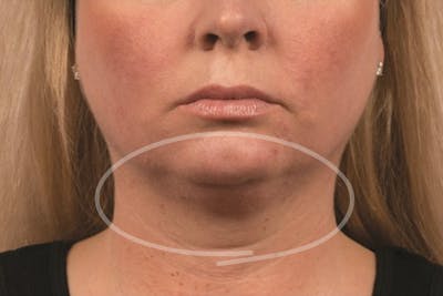 Coolsculpting Double Chin Reduction Before & After Gallery - Patient 316390 - Image 1