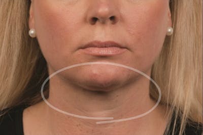 Coolsculpting Double Chin Reduction Before & After Gallery - Patient 316390 - Image 2