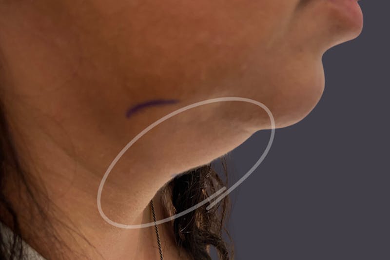 Coolsculpting Double Chin Reduction Before & After Gallery - Patient 365851 - Image 1
