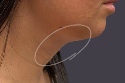 Coolsculpting Double Chin Reduction Before & After Gallery - Patient 365851 - Image 2