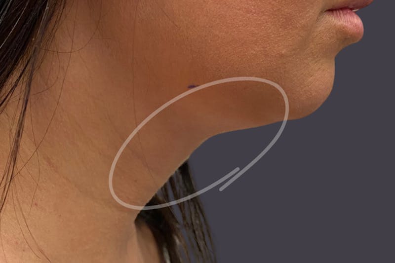 Coolsculpting Double Chin Reduction Before & After Gallery - Patient 365851 - Image 2