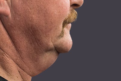 Coolsculpting Double Chin Reduction Before & After Gallery - Patient 165836 - Image 1