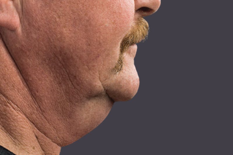 Coolsculpting Double Chin Reduction Before & After Gallery - Patient 165836 - Image 1