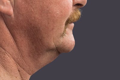 Coolsculpting Double Chin Reduction Before & After Gallery - Patient 165836 - Image 2