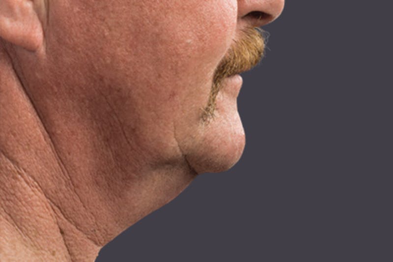 Coolsculpting Double Chin Reduction Before & After Gallery - Patient 165836 - Image 2