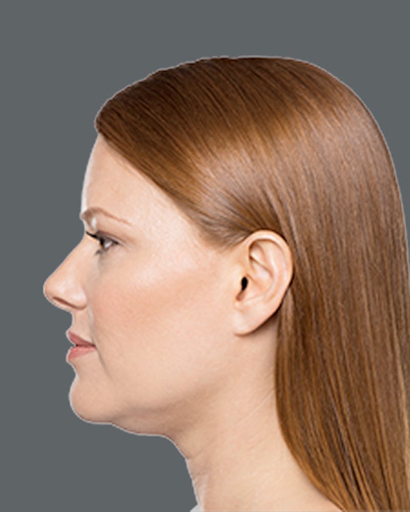 Double Chin Reduction with Kybella Before & After Gallery - Patient 288645 - Image 1