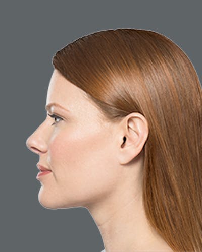 Double Chin Reduction with Kybella Before & After Gallery - Patient 288645 - Image 2