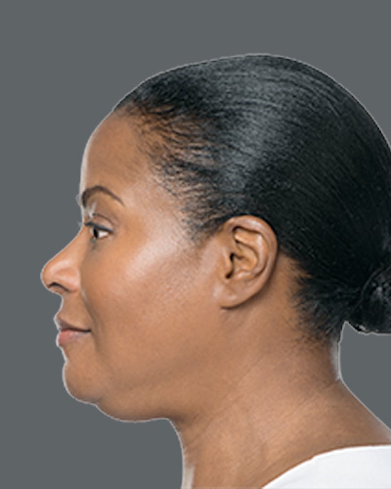 Double Chin Reduction with Kybella Before & After Gallery - Patient 645593 - Image 1
