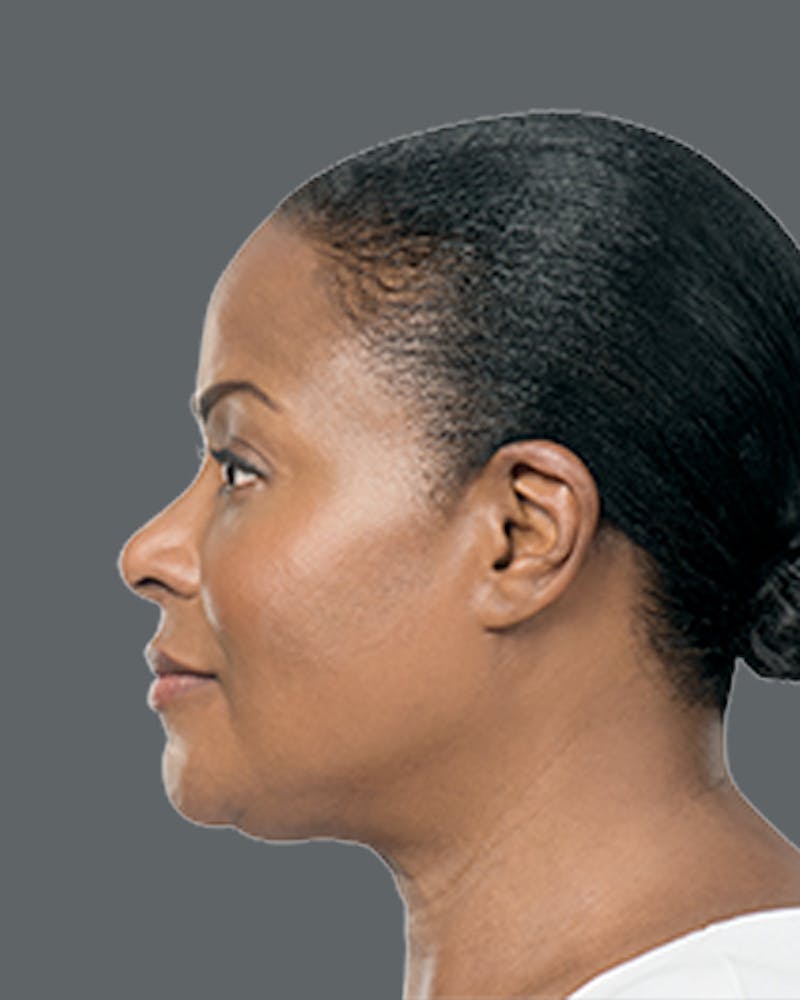 Double Chin Reduction with Kybella Before & After Gallery - Patient 645593 - Image 2